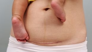 caesarean section (c section)
