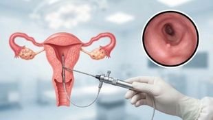 hysteroscopy